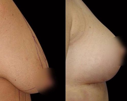 breast lift mastopexy lima peru