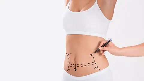 Mini abdominoplasty