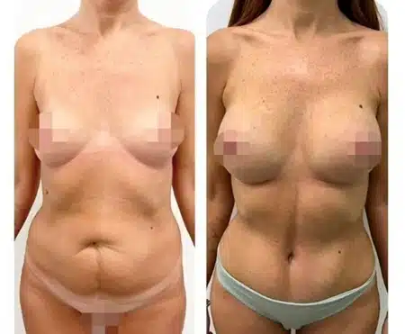 Mommy Makeover 2025