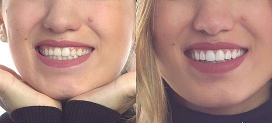 smile design