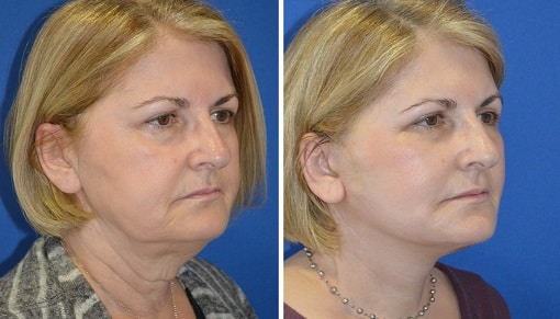 neck lift