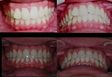 Brackets before after lima peru 
