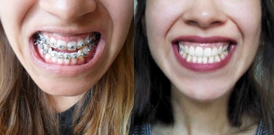 Orthognathic maxillofacial surgery