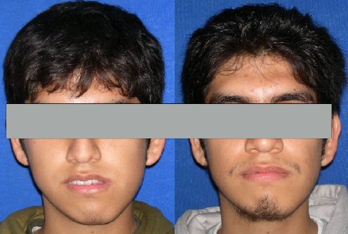 ortodoncia antes de la cirugía maxilofacial