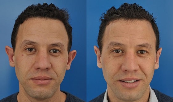 otoplasty
