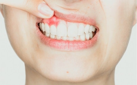 Periodontal Disease
