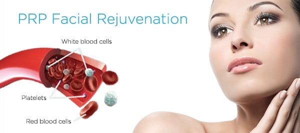 platelet rich plasma