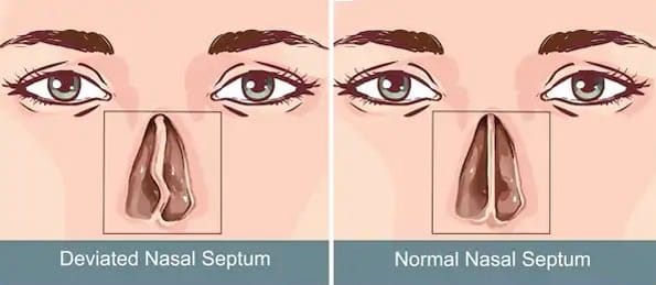 Rhinoseptoplasty
