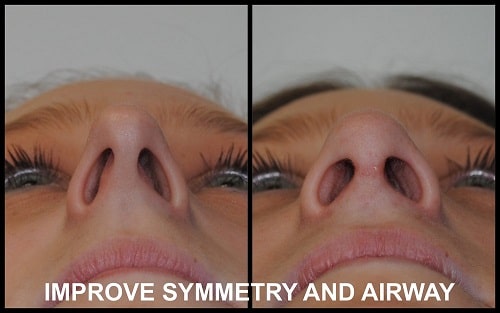 Rhinoseptoplasty