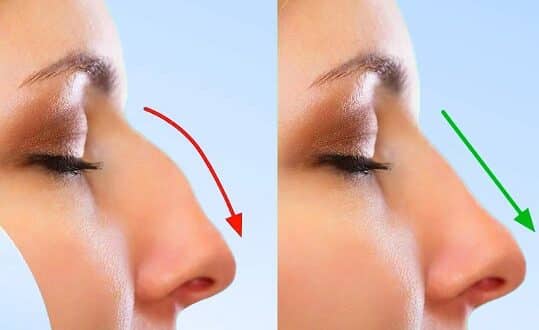 closed rhinoplasty