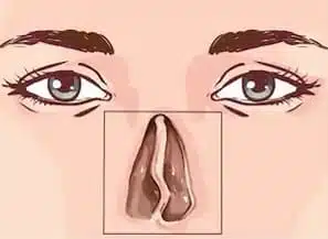 Rinoseptoplastia small rinoseptoplasty