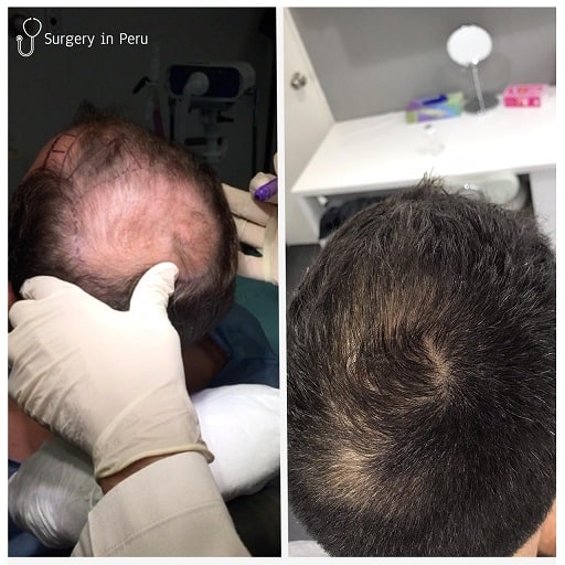 hair transplants lima peru