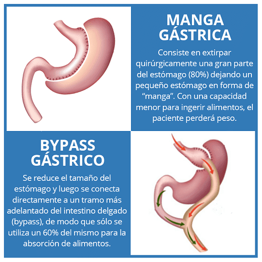 bariatric surgery lima peru