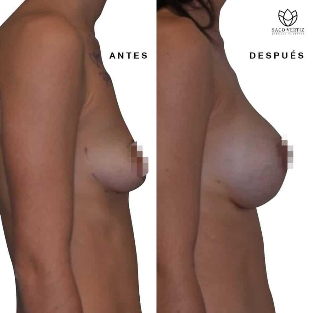 implantes de senos lima