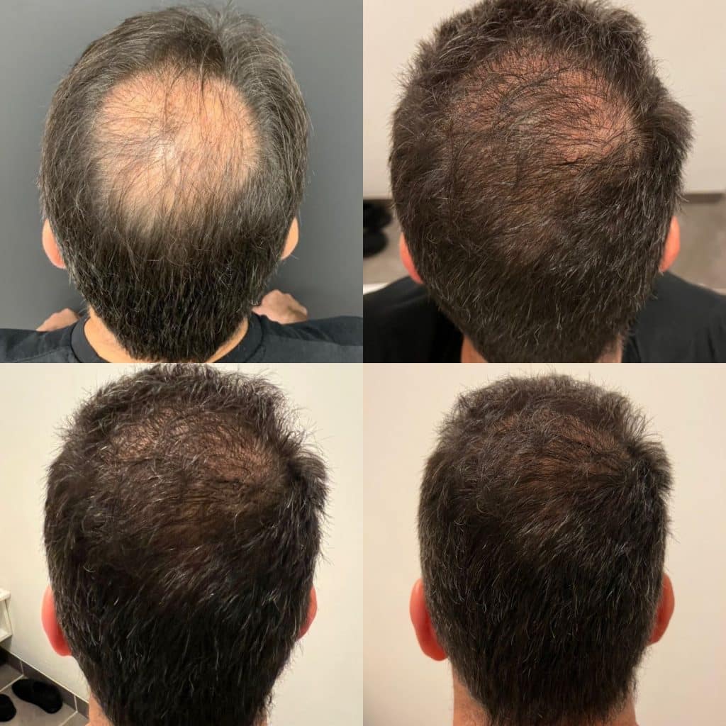 hair transplants in lima