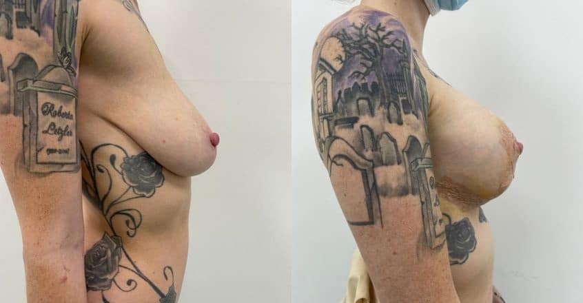 breast lift + augmentation combo