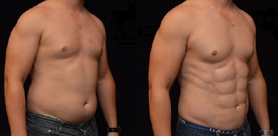 Abdominal-etching-lima