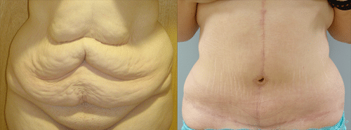 abdominoplastia Flor de Lis