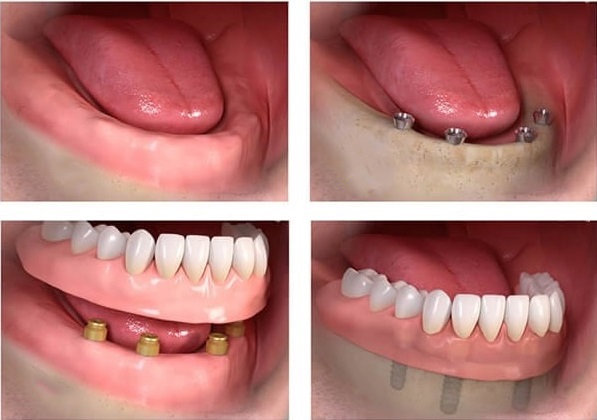 all on 4 dental implants peru