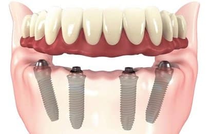 all-on-4-dental-implants-lima-peru