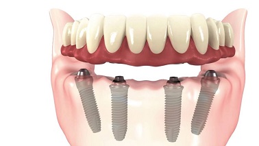 all on 4 implantes dentales lima peru