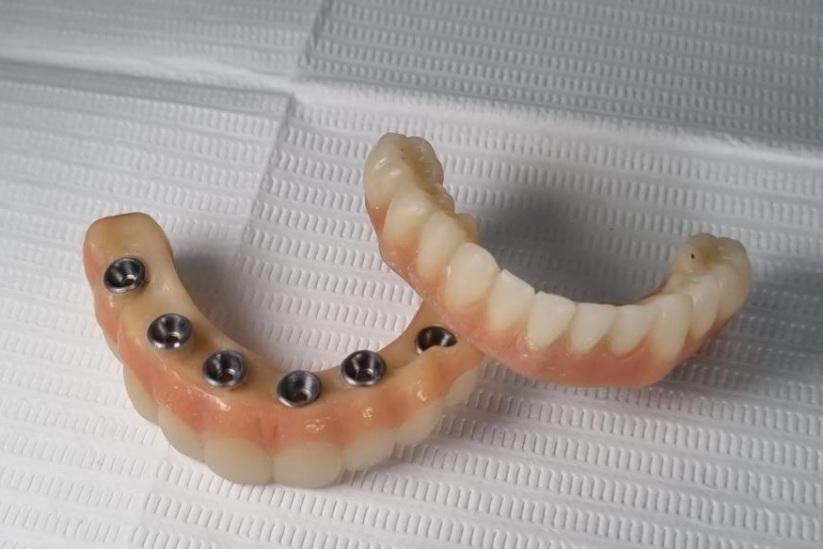 Straumann dental implants lima peru