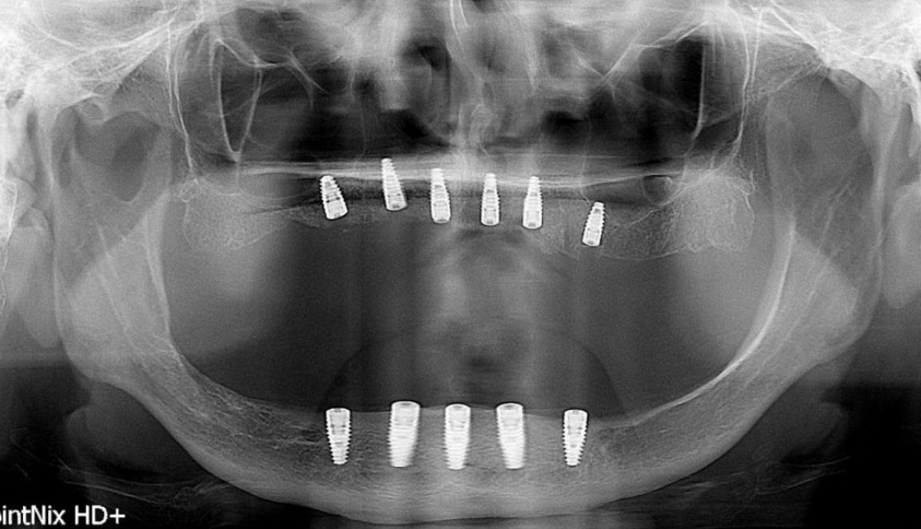 straumann implantes dentales
all on 6