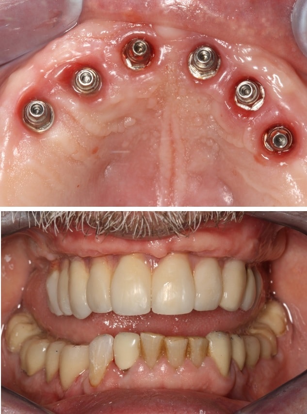 all on 6 dental implants surgery in lima peru