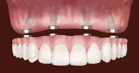 all on 4 implantes dentales lima peru