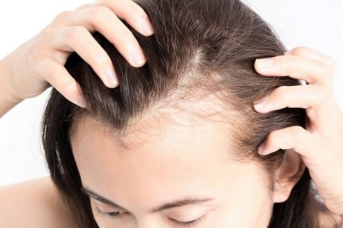 alopecia femenina