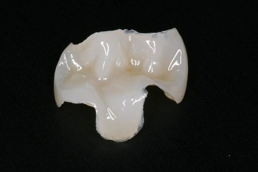 amalgam removal