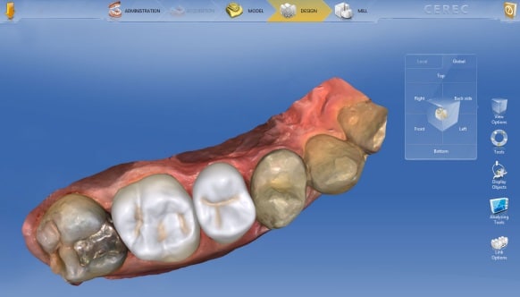 amalgam fillings
