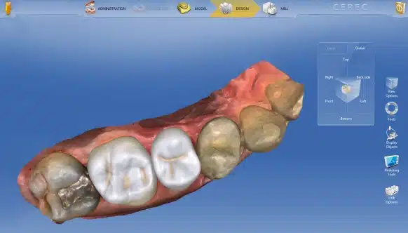amalgam fillings