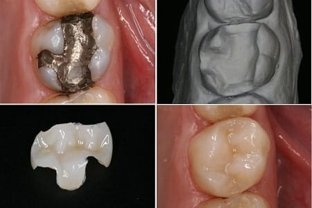 cerec replacement amalgams