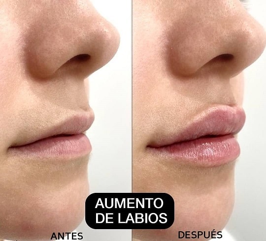 lip augmentation lima peru