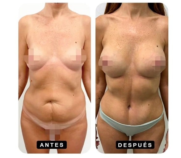 aumento de senos y abdominoplastia