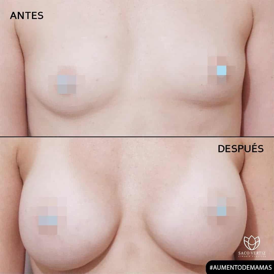 aumento de mamas opciones