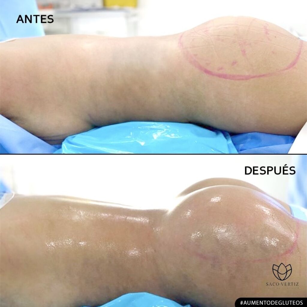 aumento de gluteos lima