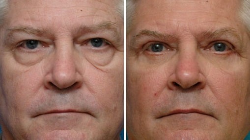 blefaroplasty lima peru