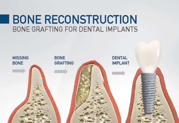 bone graft