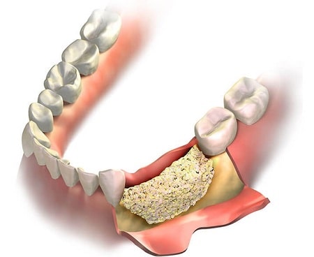 bone graft