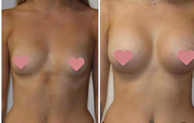 implantes de senos lima