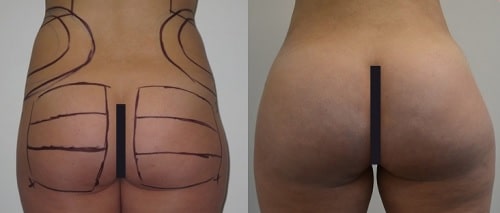 Gluteoplastia en Lima