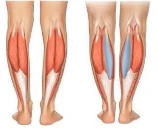 calf implants calf implants lima