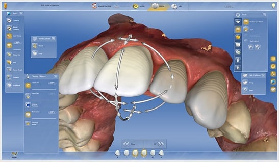 dental veneer scan