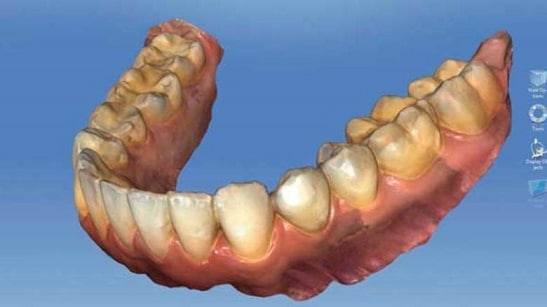 cerec scan veneers