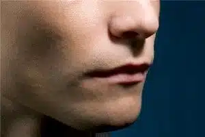 chin implant surgeryinperu chin implant