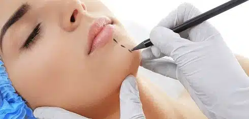 chin implant lima