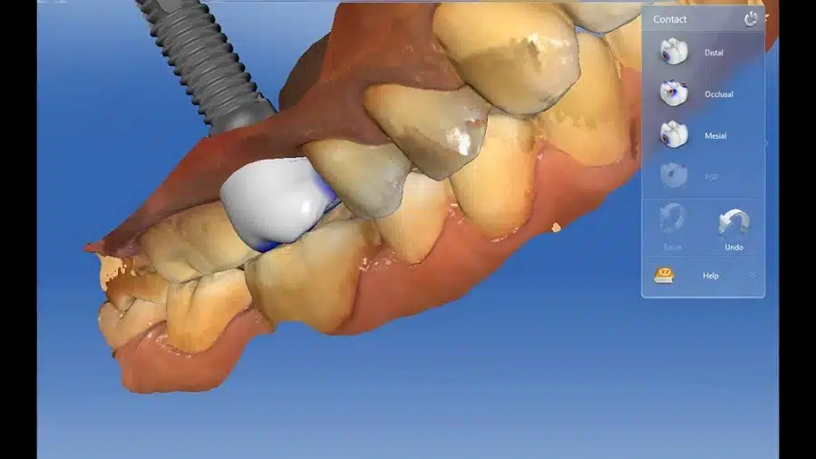 crown over implant zirconium dental implants in Lima, Peru