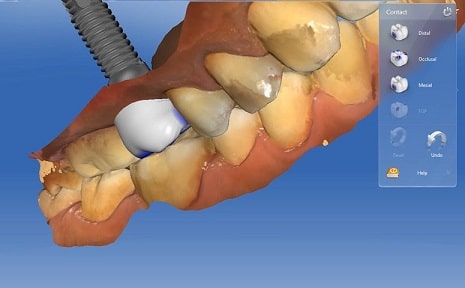 Digital Implantology
